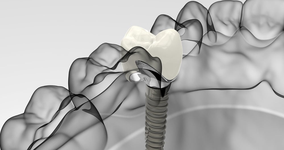 Dental Implant Professionals