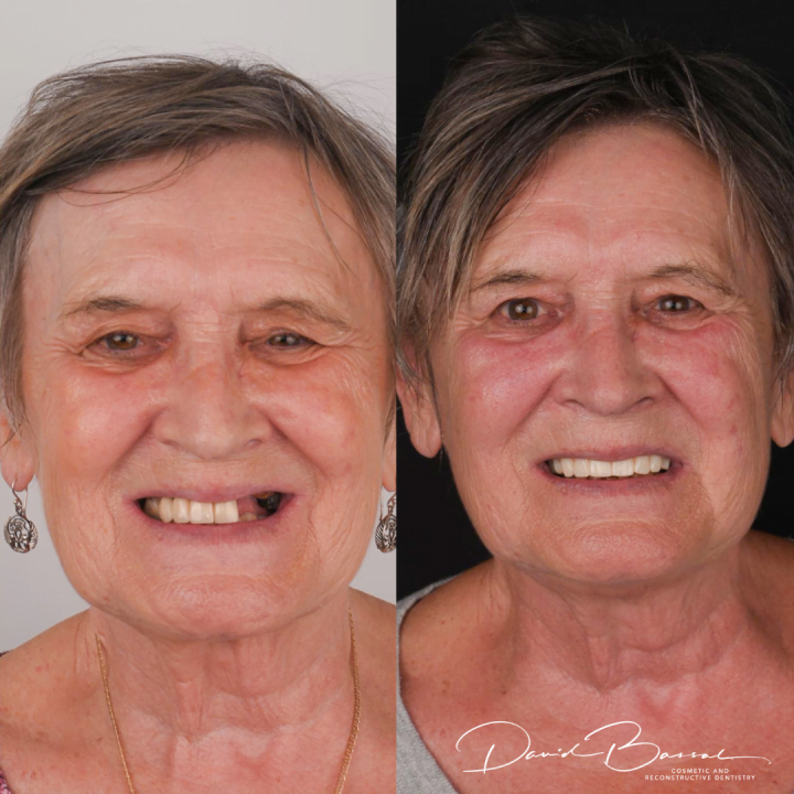 dental implants teeth on before and after