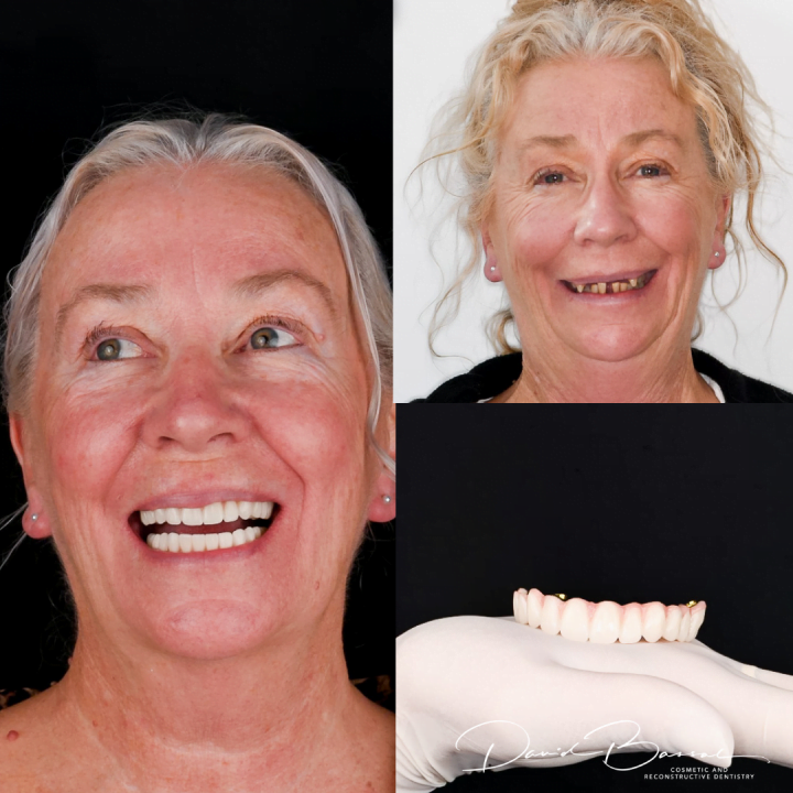 dental implants teeth on before and after