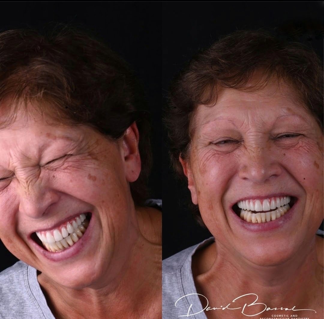 dental implants teeth on implants before and after