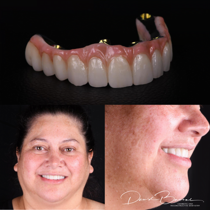 dental implants teeth on before and after