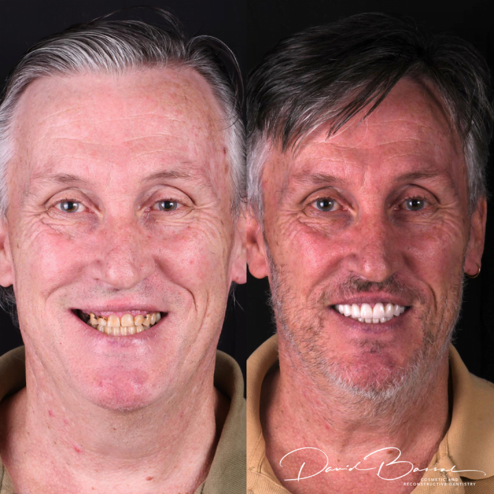 veneers before and after